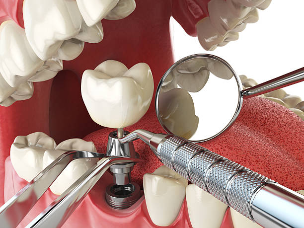 Best Emergency Treatment for Dental Infections or Abscesses in Pompton Lakes, NJ